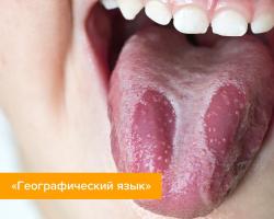 Причины, симптомы и лечение желтого налета на языке
